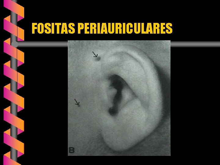 FOSITAS PERIAURICULARES 