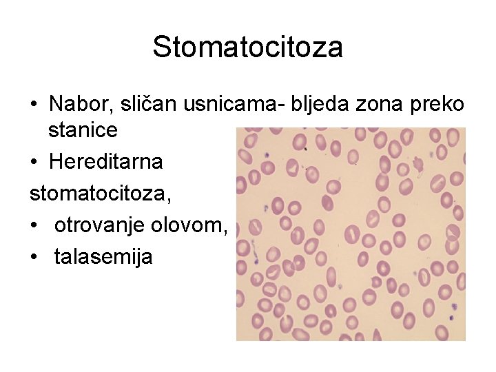 Stomatocitoza • Nabor, sličan usnicama- bljeda zona preko stanice • Hereditarna stomatocitoza, • otrovanje