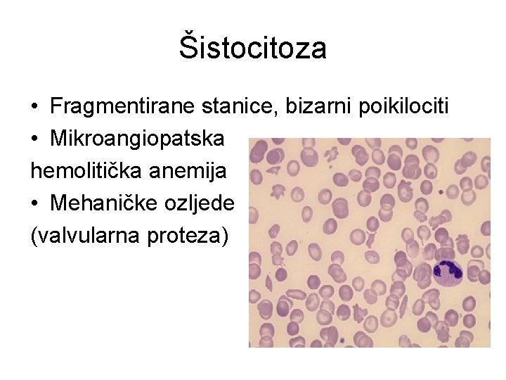 Šistocitoza • Fragmentirane stanice, bizarni poikilociti • Mikroangiopatska hemolitička anemija • Mehaničke ozljede (valvularna