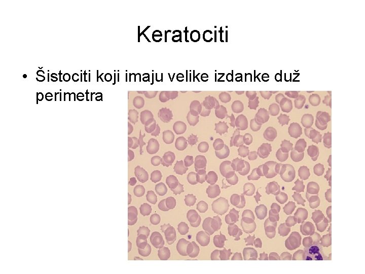 Keratociti • Šistociti koji imaju velike izdanke duž perimetra 