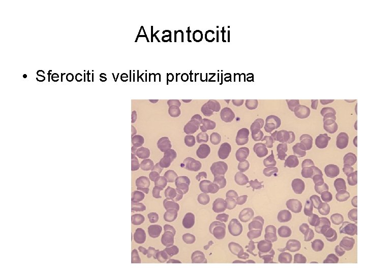 Akantociti • Sferociti s velikim protruzijama 