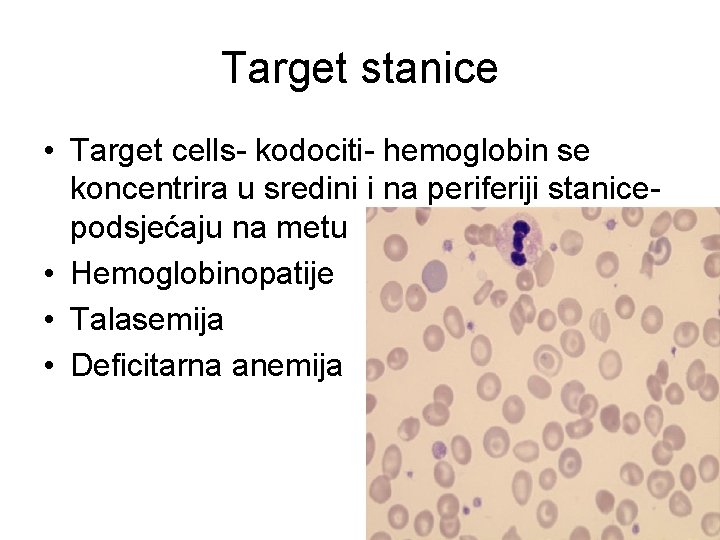 Target stanice • Target cells- kodociti- hemoglobin se koncentrira u sredini i na periferiji