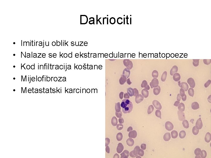 Dakriociti • • • Imitiraju oblik suze Nalaze se kod ekstramedularne hematopoeze Kod infiltracija