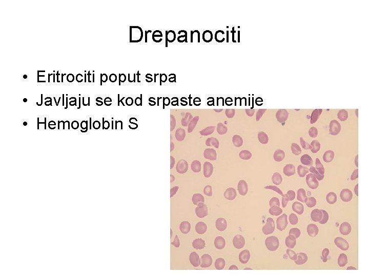 Drepanociti • Eritrociti poput srpa • Javljaju se kod srpaste anemije • Hemoglobin S