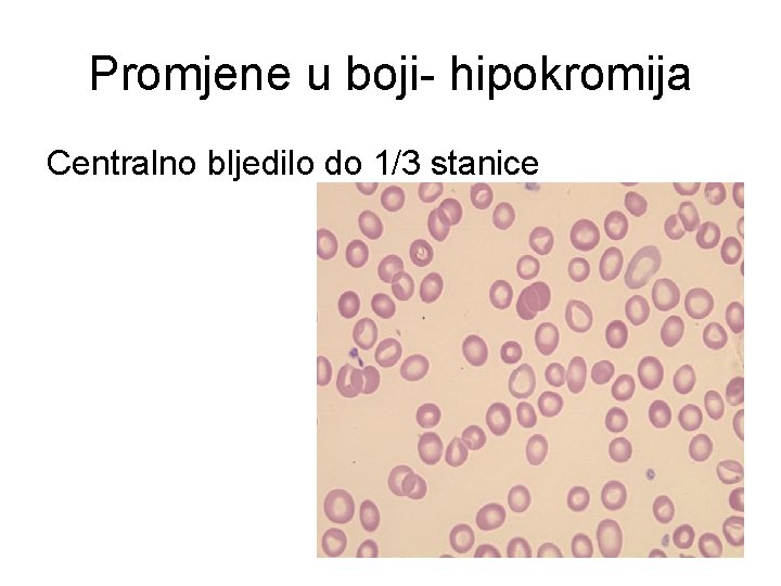 Promjene u boji- hipokromija Centralno bljedilo do 1/3 stanice 