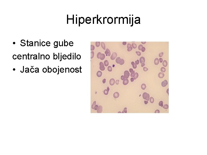 Hiperkrormija • Stanice gube centralno bljedilo • Jača obojenost 