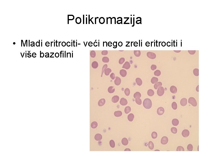 Polikromazija • Mladi eritrociti- veći nego zreli eritrociti i više bazofilni 