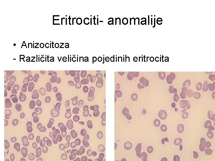 Eritrociti- anomalije • Anizocitoza - Različita veličina pojedinih eritrocita 