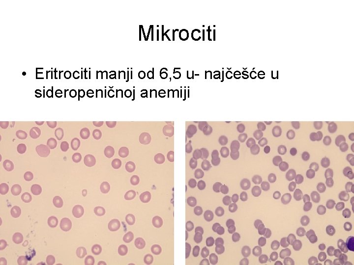 Mikrociti • Eritrociti manji od 6, 5 u- najčešće u sideropeničnoj anemiji 