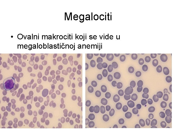 Megalociti • Ovalni makrociti koji se vide u megaloblastičnoj anemiji 