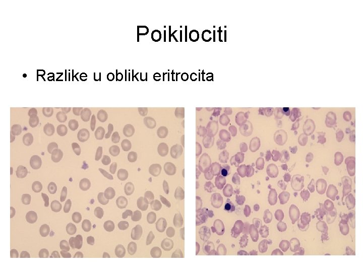 Poikilociti • Razlike u obliku eritrocita 