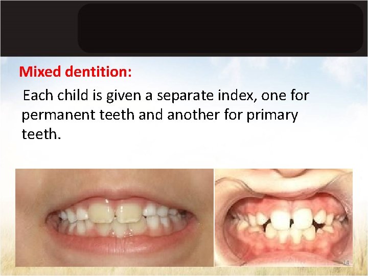 Mixed dentition: Each child is given a separate index, one for permanent teeth and