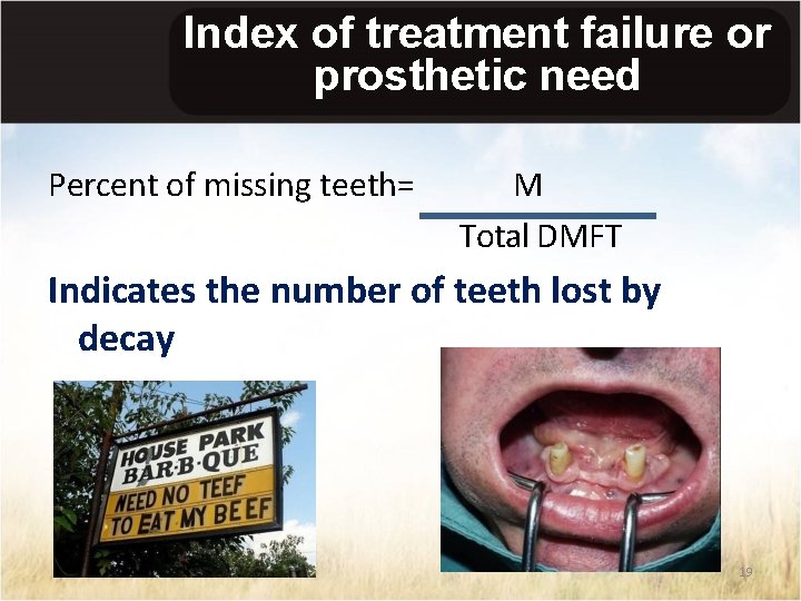 Index of treatment failure or prosthetic need Percent of missing teeth= M Total DMFT