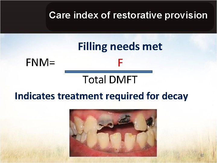 Care index of restorative provision FNM= Filling needs met F Total DMFT Indicates treatment