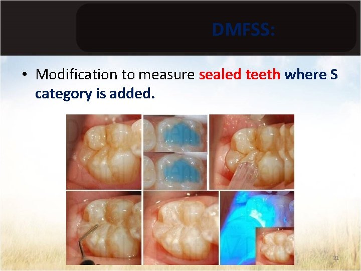 DMFSS: • Modification to measure sealed teeth where S category is added. 21 