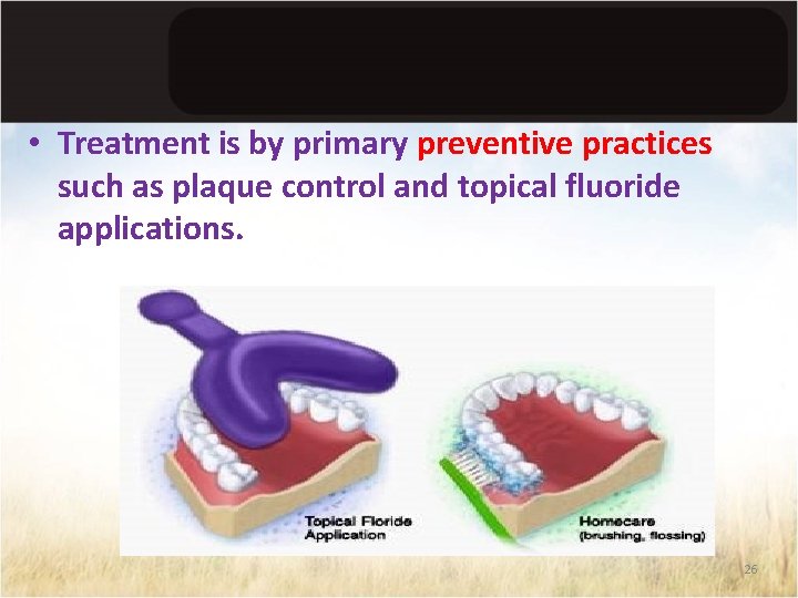  • Treatment is by primary preventive practices such as plaque control and topical