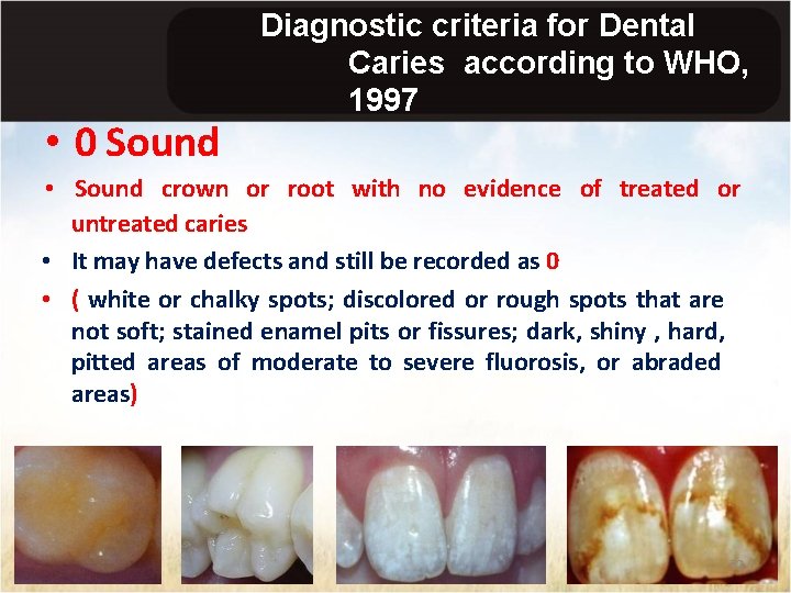  • 0 Sound Diagnostic criteria for Dental Caries according to WHO, 1997 •