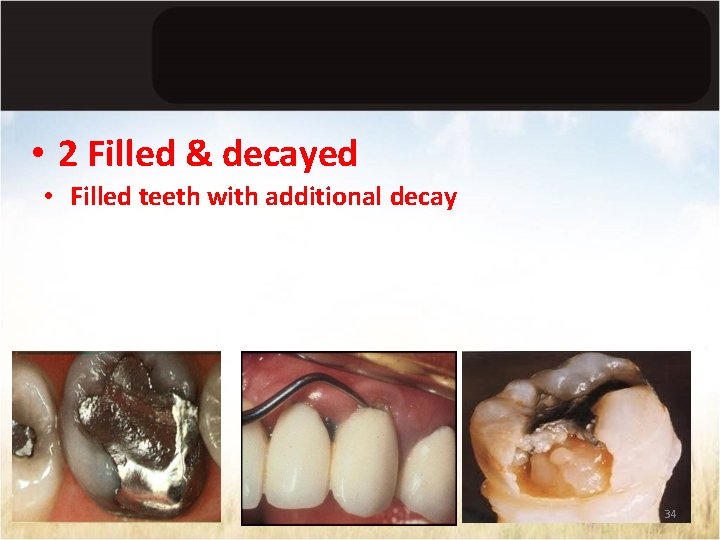  • 2 Filled & decayed • Filled teeth with additional decay 34 