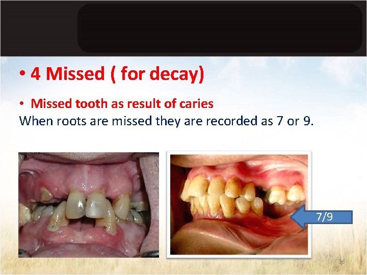  • 4 Missed ( for decay) • Missed tooth as result of caries