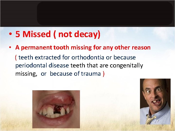  • 5 Missed ( not decay) • A permanent tooth missing for any