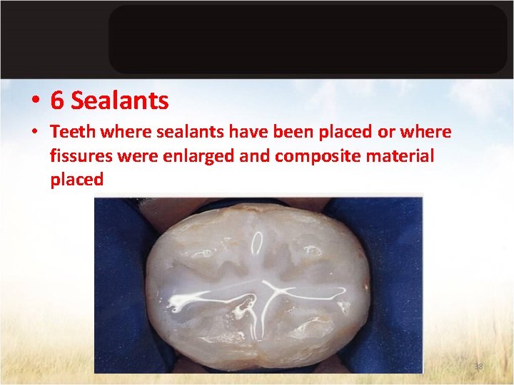  • 6 Sealants • Teeth where sealants have been placed or where fissures