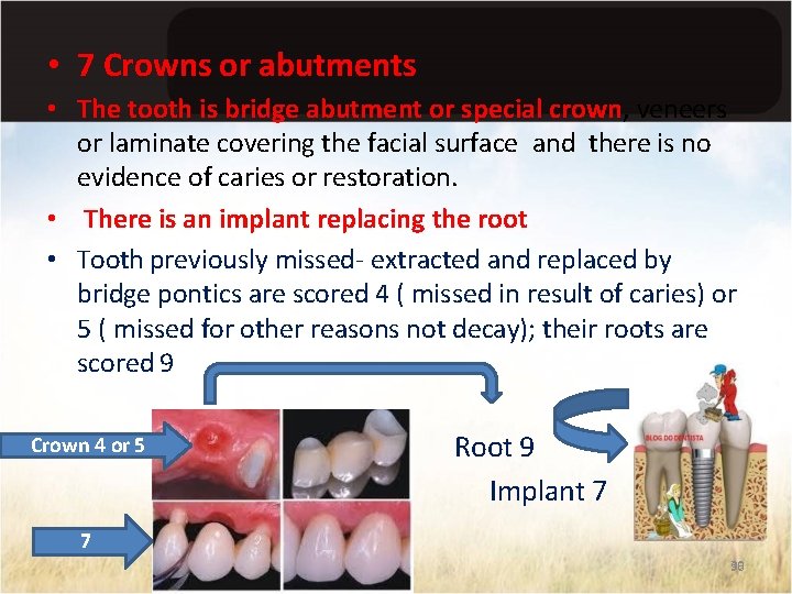  • 7 Crowns or abutments • The tooth is bridge abutment or special