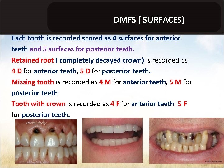 DMFS ( SURFACES) Each tooth is recorded scored as 4 surfaces for anterior teeth