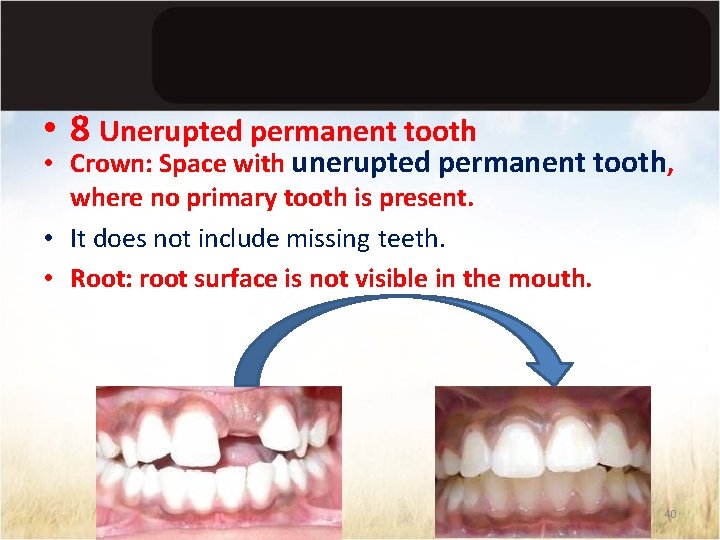  • 8 Unerupted permanent tooth • Crown: Space with unerupted permanent tooth, where