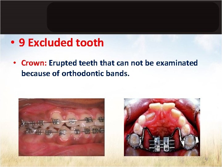  • 9 Excluded tooth • Crown: Erupted teeth that can not be examinated