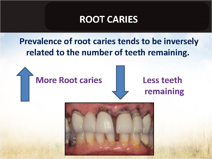 ROOT CARIES Prevalence of root caries tends to be inversely related to the number