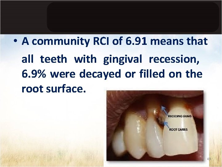  • A community RCI of 6. 91 means that all teeth with gingival