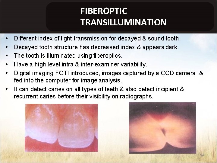 FIBEROPTIC TRANSILLUMINATION • • • Different index of light transmission for decayed & sound