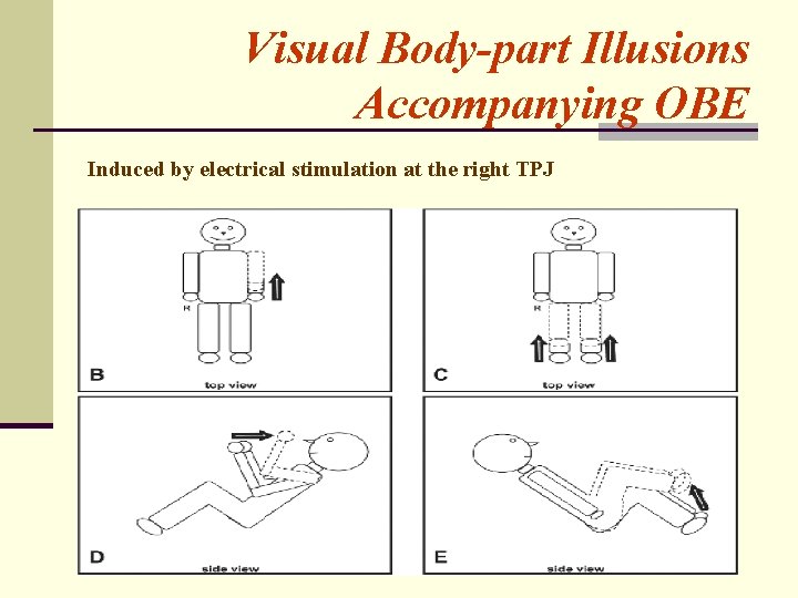 Visual Body-part Illusions Accompanying OBE Induced by electrical stimulation at the right TPJ 