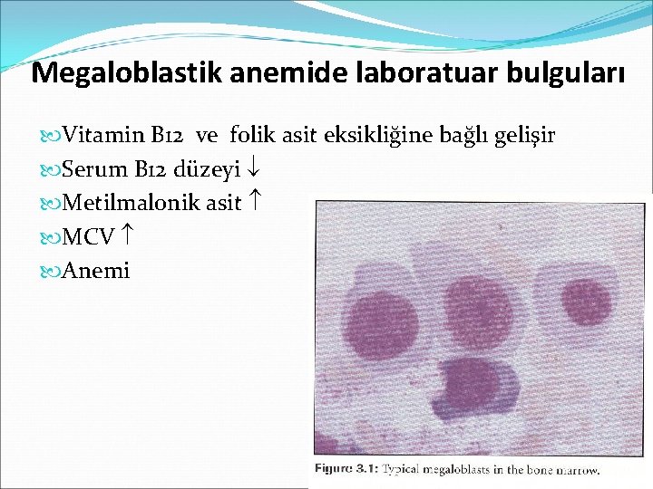 Megaloblastik anemide laboratuar bulguları Vitamin B 12 ve folik asit eksikliğine bağlı gelişir Serum