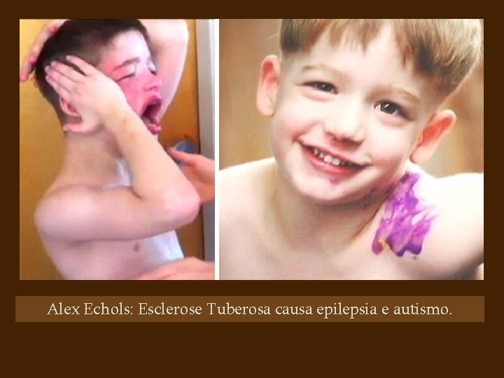 Alex Echols: Esclerose Tuberosa causa epilepsia e autismo. 
