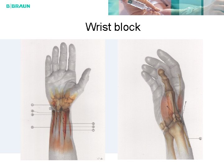 Wrist block 