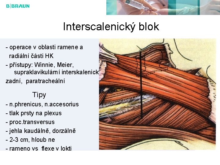 Interscalenický blok - operace v oblasti ramene a radiální části HK - přístupy: Winnie,