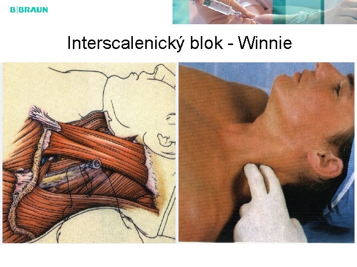 Interscalenický blok - Winnie 