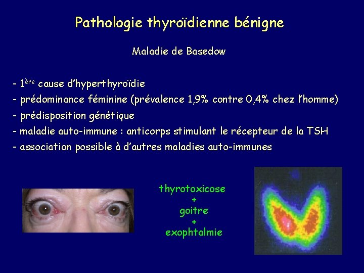 Pathologie thyroïdienne bénigne Maladie de Basedow - 1ère cause d’hyperthyroïdie - prédominance féminine (prévalence