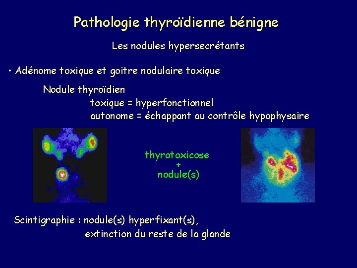 Pathologie thyroïdienne bénigne Les nodules hypersecrétants • Adénome toxique et goitre nodulaire toxique Nodule