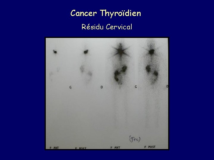 Cancer Thyroïdien Résidu Cervical 