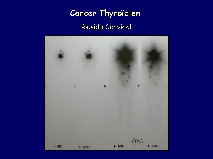 Cancer Thyroïdien Résidu Cervical 