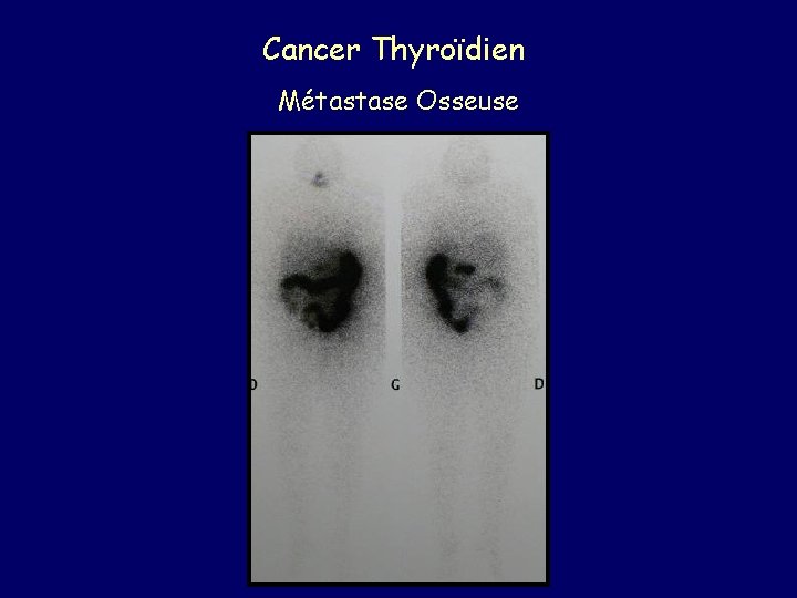 Cancer Thyroïdien Métastase Osseuse 