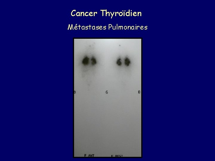 Cancer Thyroïdien Métastases Pulmonaires 