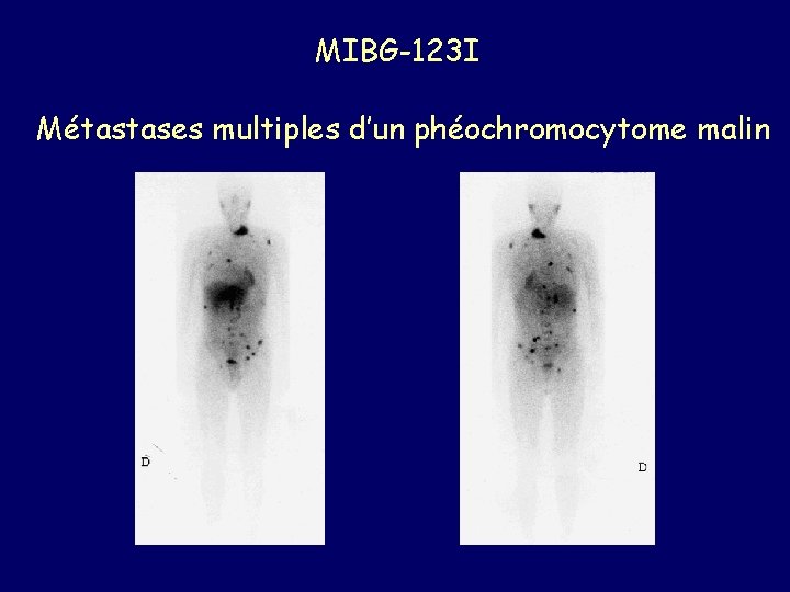 MIBG-123 I Métastases multiples d’un phéochromocytome malin 