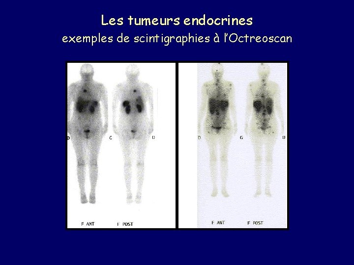 Les tumeurs endocrines exemples de scintigraphies à l’Octreoscan 