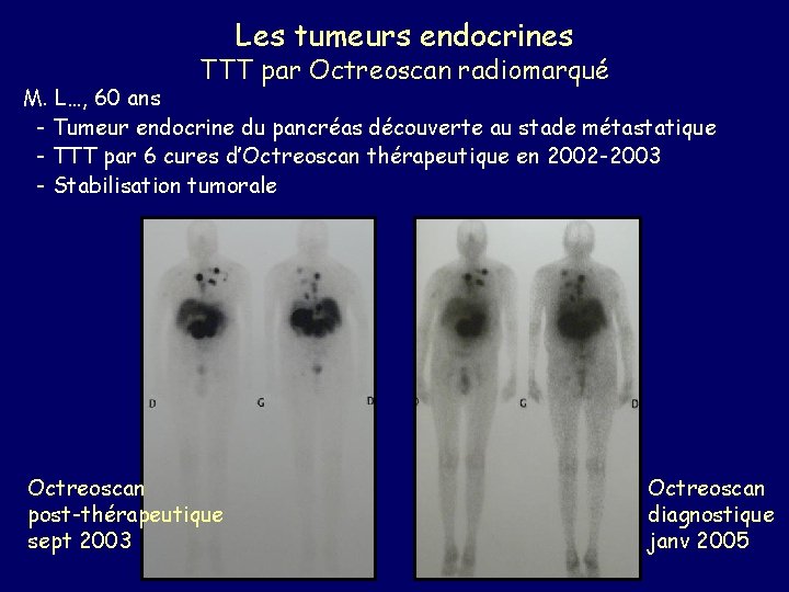 Les tumeurs endocrines TTT par Octreoscan radiomarqué M. L…, 60 ans - Tumeur endocrine