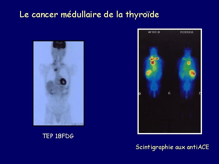 Le cancer médullaire de la thyroïde TEP 18 FDG Scintigraphie aux anti. ACE 