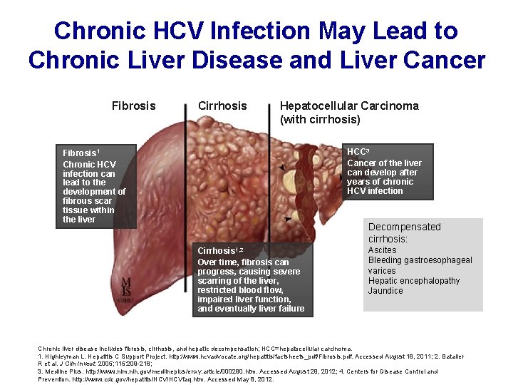 Chronic HCV Infection May Lead to Chronic Liver Disease and Liver Cancer Fibrosis Cirrhosis