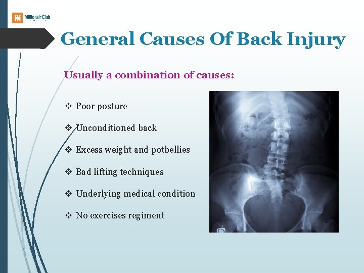 General Causes Of Back Injury Usually a combination of causes: v Poor posture v